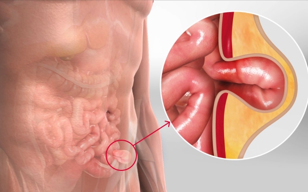 Hernia
