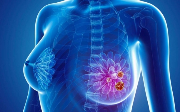 Breast Lump Removal (Lumpectomy)