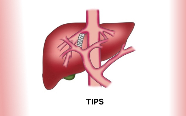 Transjugular Intrahepatic Portosystemic Shunt (TIPS)